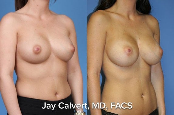 breast implants beverly hills