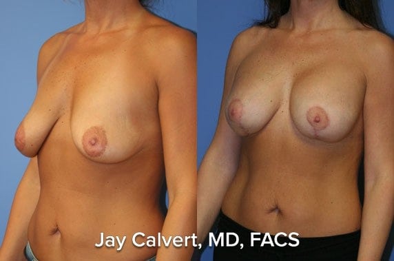 breast lift beverly hills
