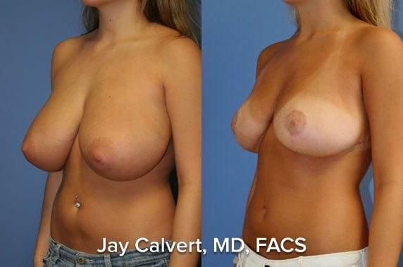 los angeles breast reduction