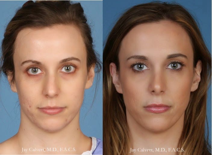 Primary rhinoplasty for crooked nose in Beverly Hills