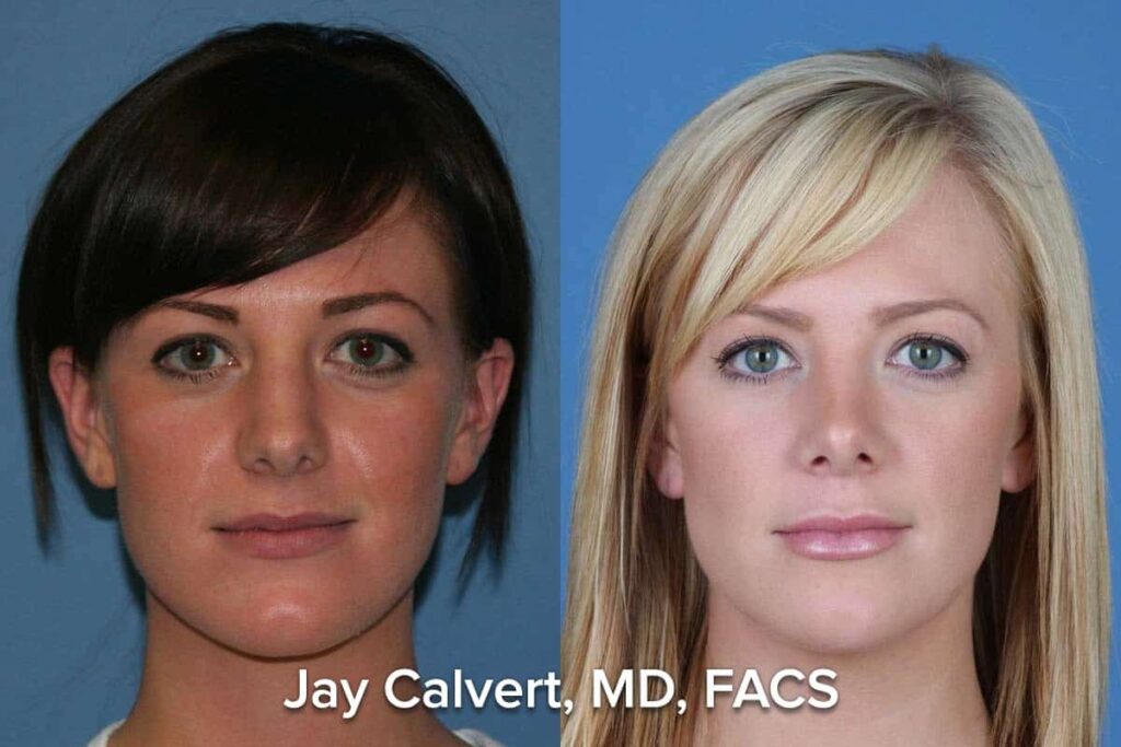 rhinoplasty before and after patient