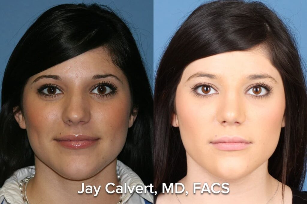 ethnic rhinoplasty before and after patient