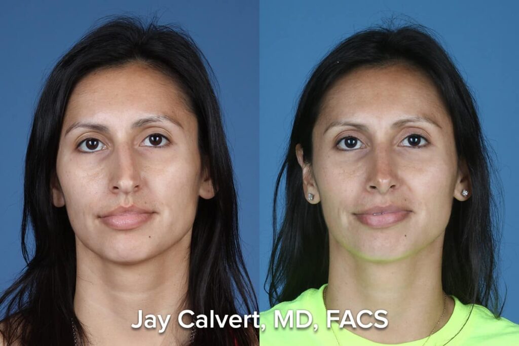 crooked nose treated with primary rhinoplasty