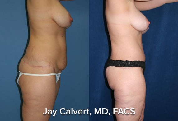 body lift surgery before and after photos