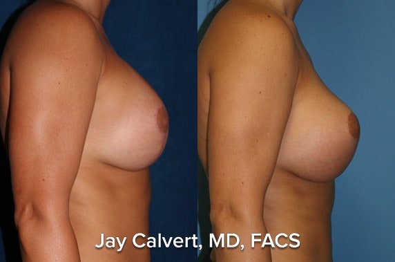 capsulectomy results