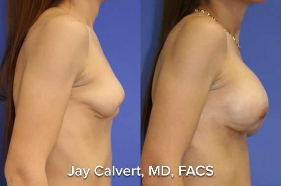 breast reconstruction before and afters