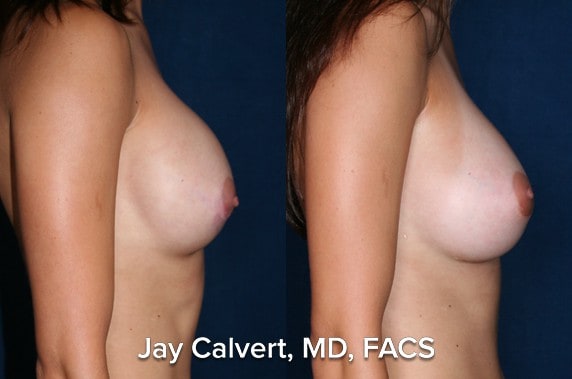 capsulectomy before an after la