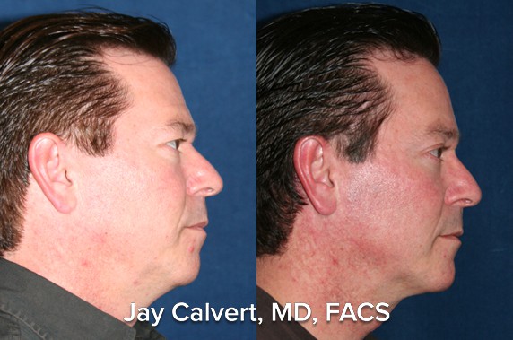 facelift before and after pics