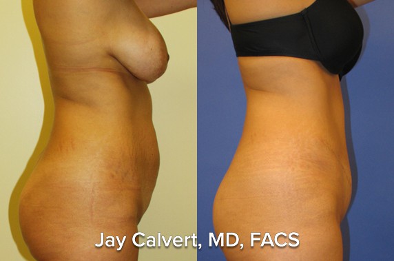 abdominoplasty before and after pics