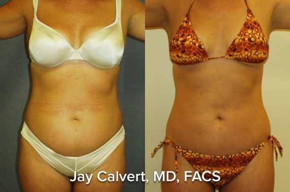 liposuction pictures