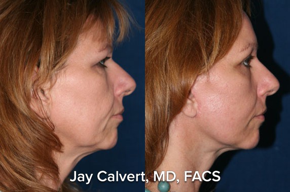 facelift before and after patient