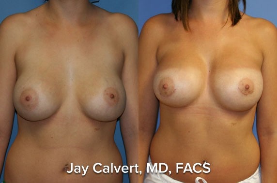 breast lift before and after images