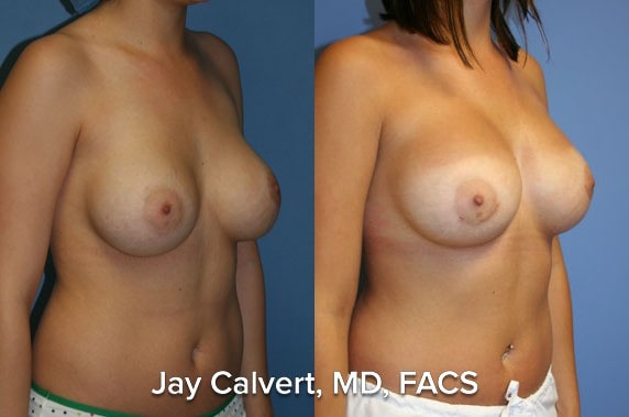 breast lift before and after results