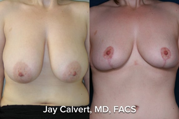 breast reduction images