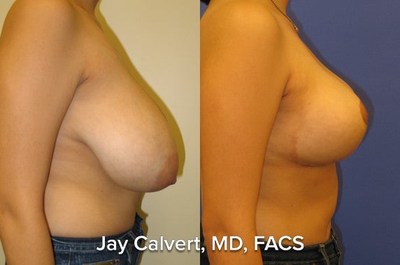 breast reduction best results