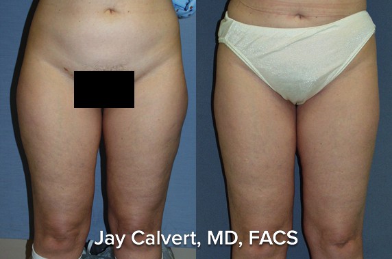 tummy liposuction before and after