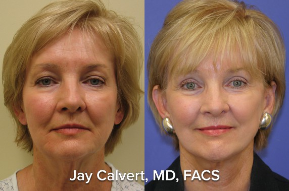 facelift before and after patient