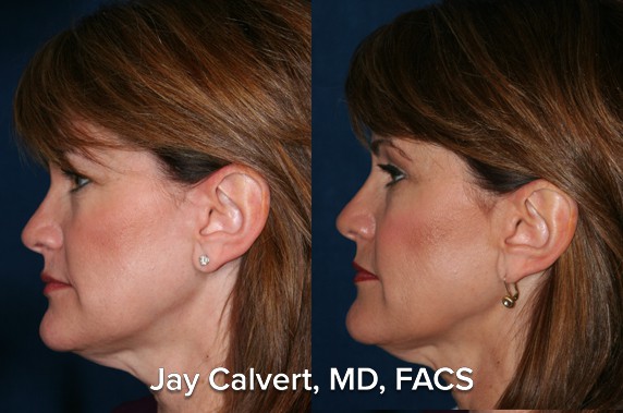 facelift before and after beverly hills