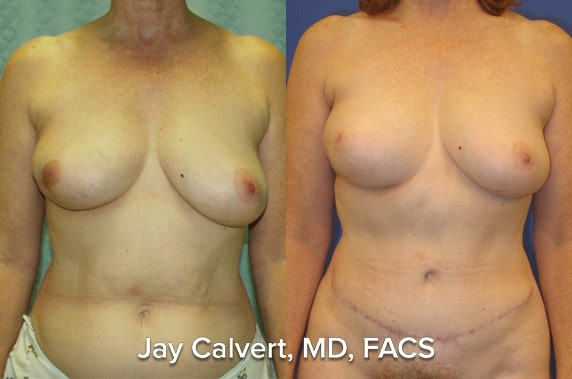 breast reconstruction before and after photos