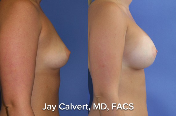 breast augmentation plastic surgeon results