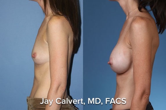 natural breast augmentation photos