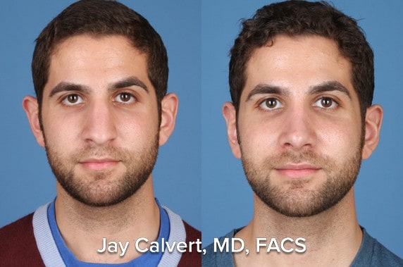 revision rhinoplasty before and after patient