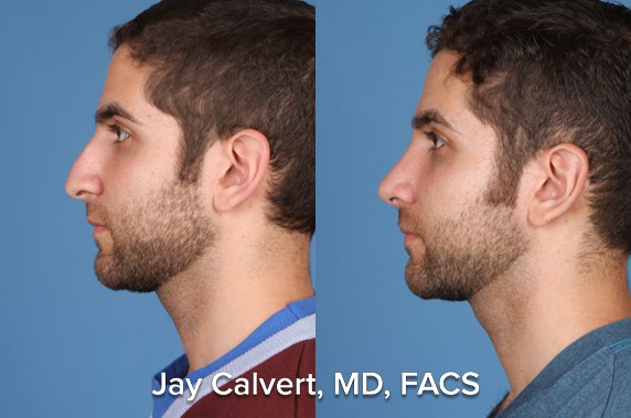 otoplasty before and after patient