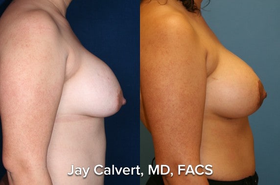 Breast implant exchange and mastopexy by Dr. Jay Calvert, Beverly Hills Plastic Surgeon