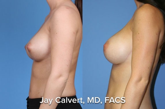 breast augmentation before and after pics