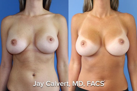 capsulectomy results in beverly hills