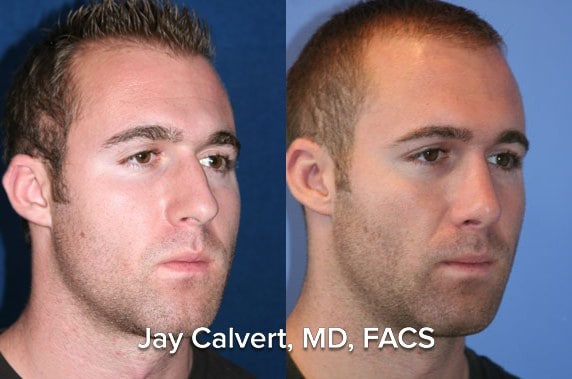 rhinoplasty before and after patient