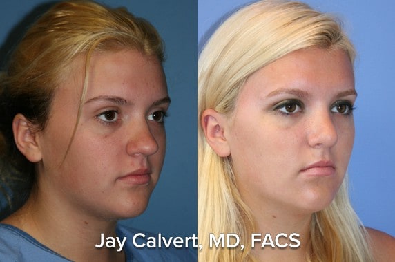 teenage rhinoplasty before and after patient