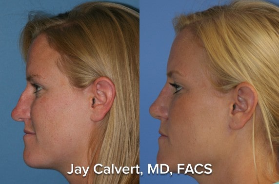 teenage rhinoplasty before and after patient