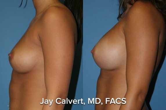 breast implant images