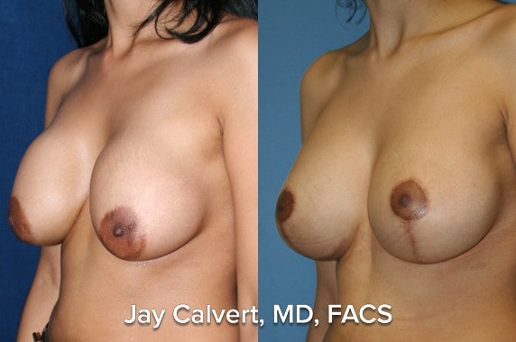 beverly hills breast lift results