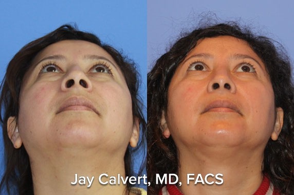 ethnic rhinoplasty before and after patient