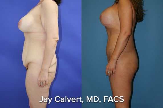 body lift surgery before and after