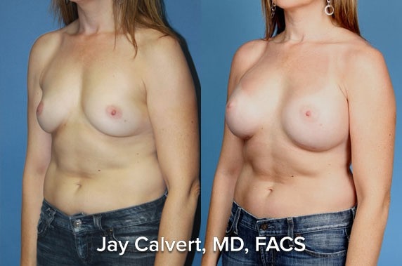 best breast augmentation before and after results