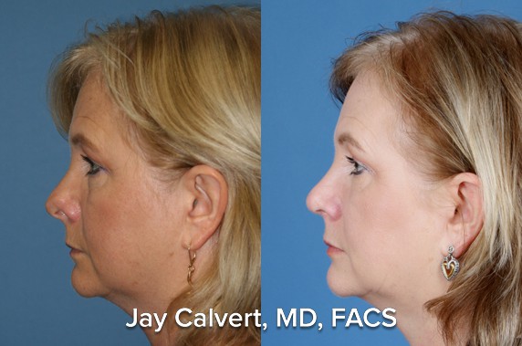 revision rhinoplasty with rib graft before and after