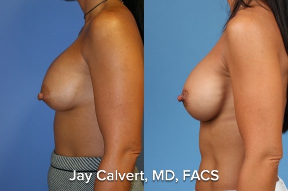 breast reconstruction results beverly hills