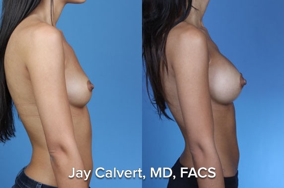 perfect boob job before and afters