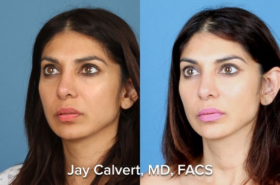 revision rhinoplasty with rib graft before and after