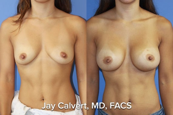 hollywood breast implant surgery results
