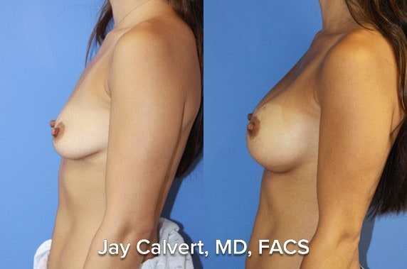 plastic surgeon breast aug results