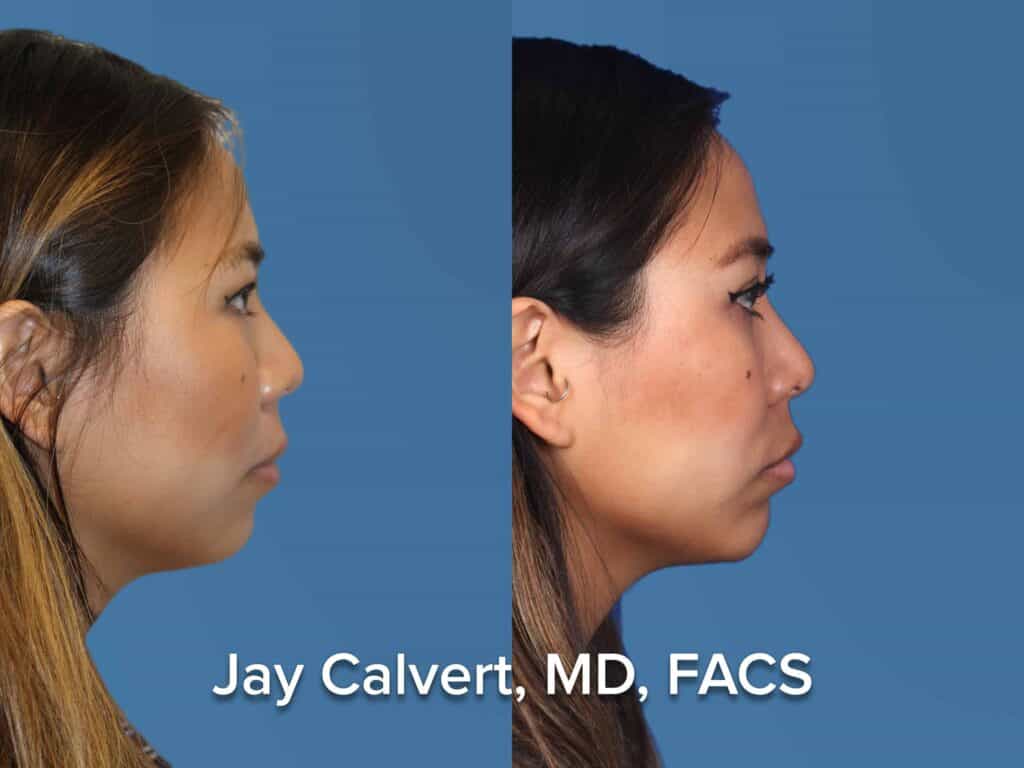 Ethnic Female Rhinoplasty before and afters