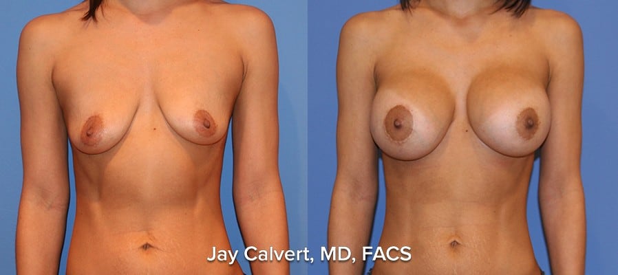 breast implants los angeles results