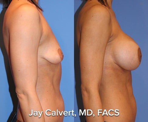 breast implants results in los angeles
