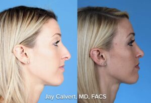 rhinoplasty female by Dr. Jay Calvert