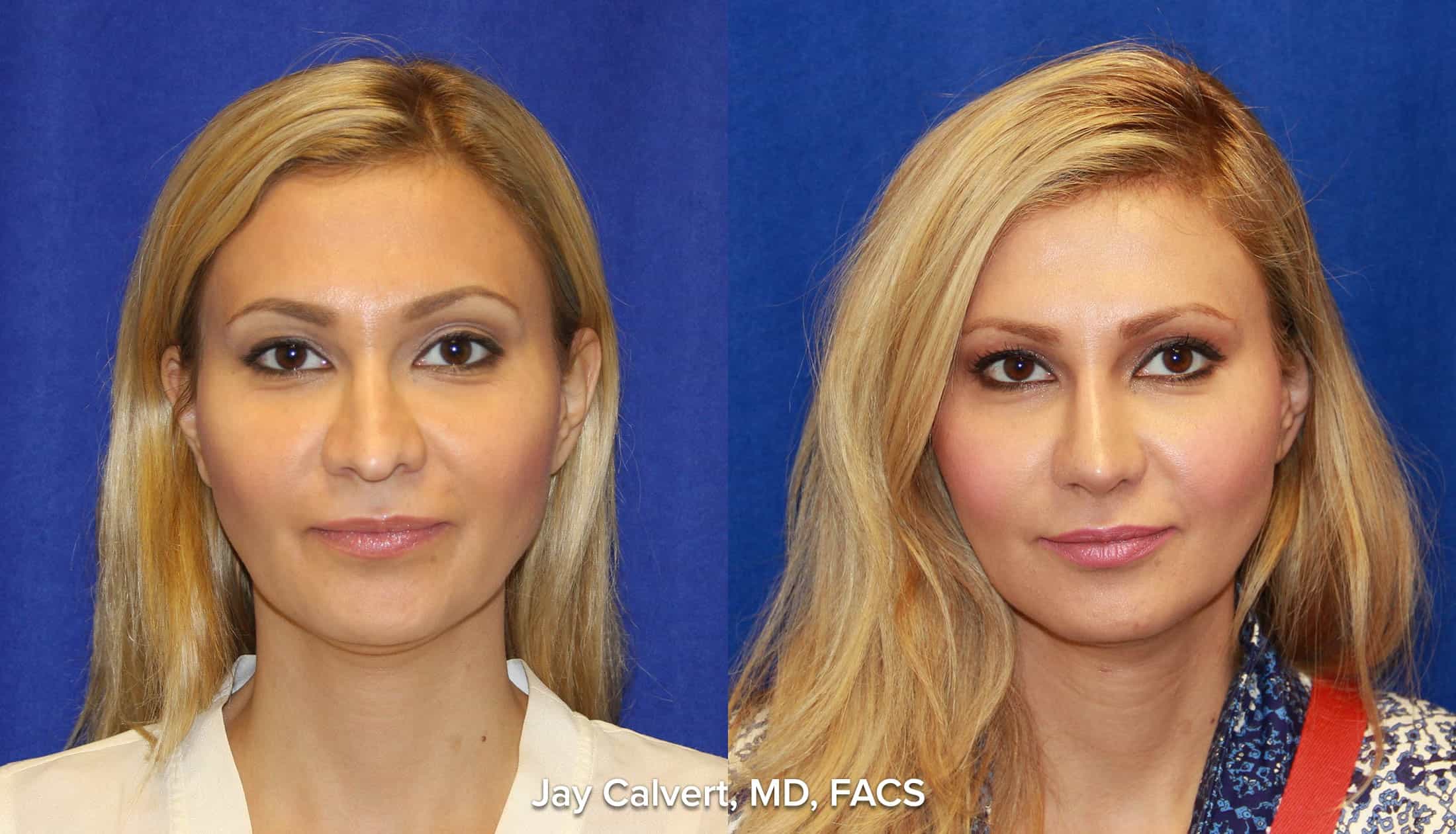 before and after photograph of a rib graft reconstructive rhinoplasty