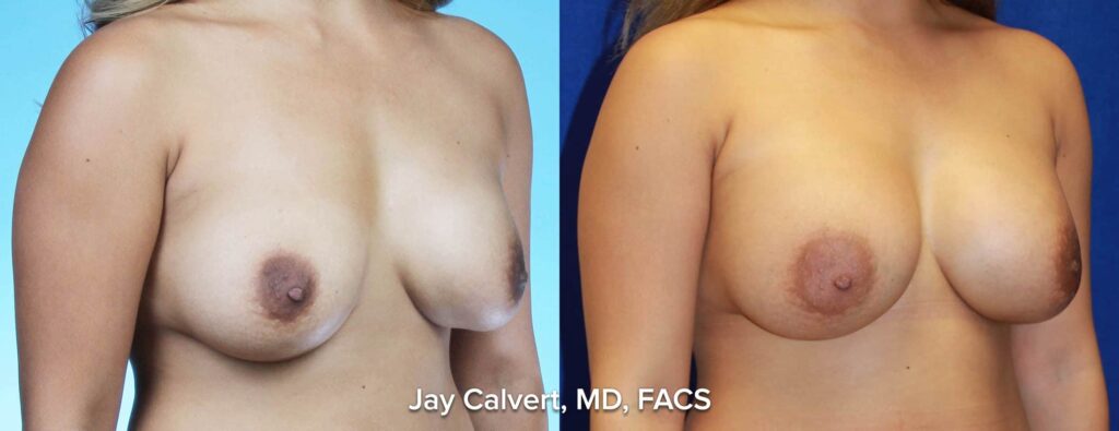 breast augmentation results in LA